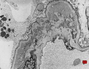 M,44y. | IgA nephropathy M,44y. | IgA nephropathy